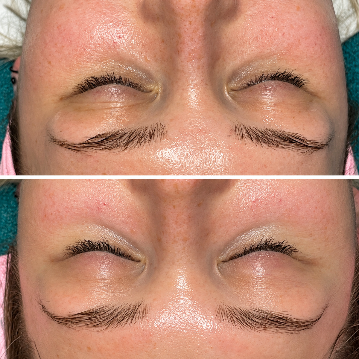 Diamant-Mikrodermabrasion bei simply drop