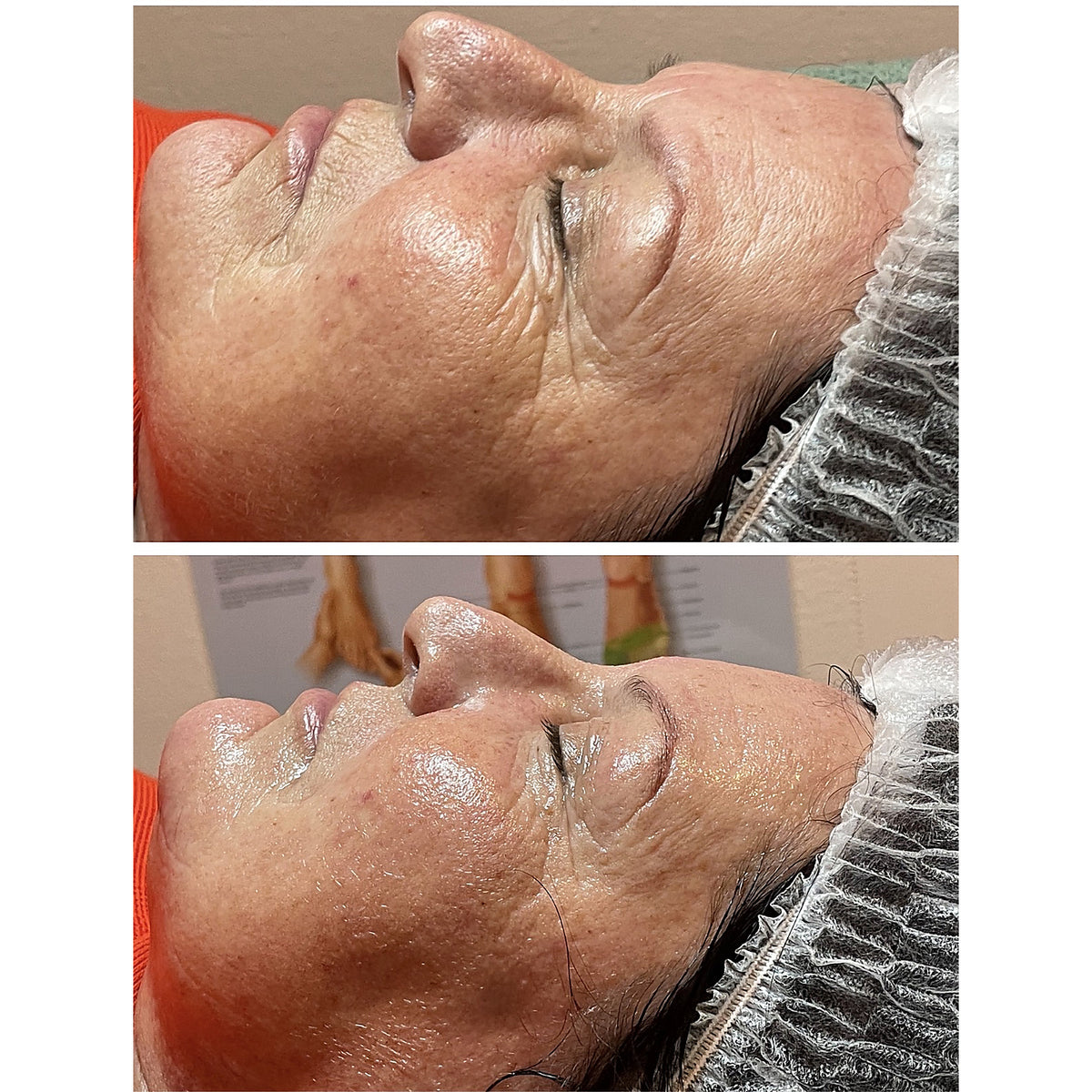 Kosmetisches Fadenlifting bei simply drop