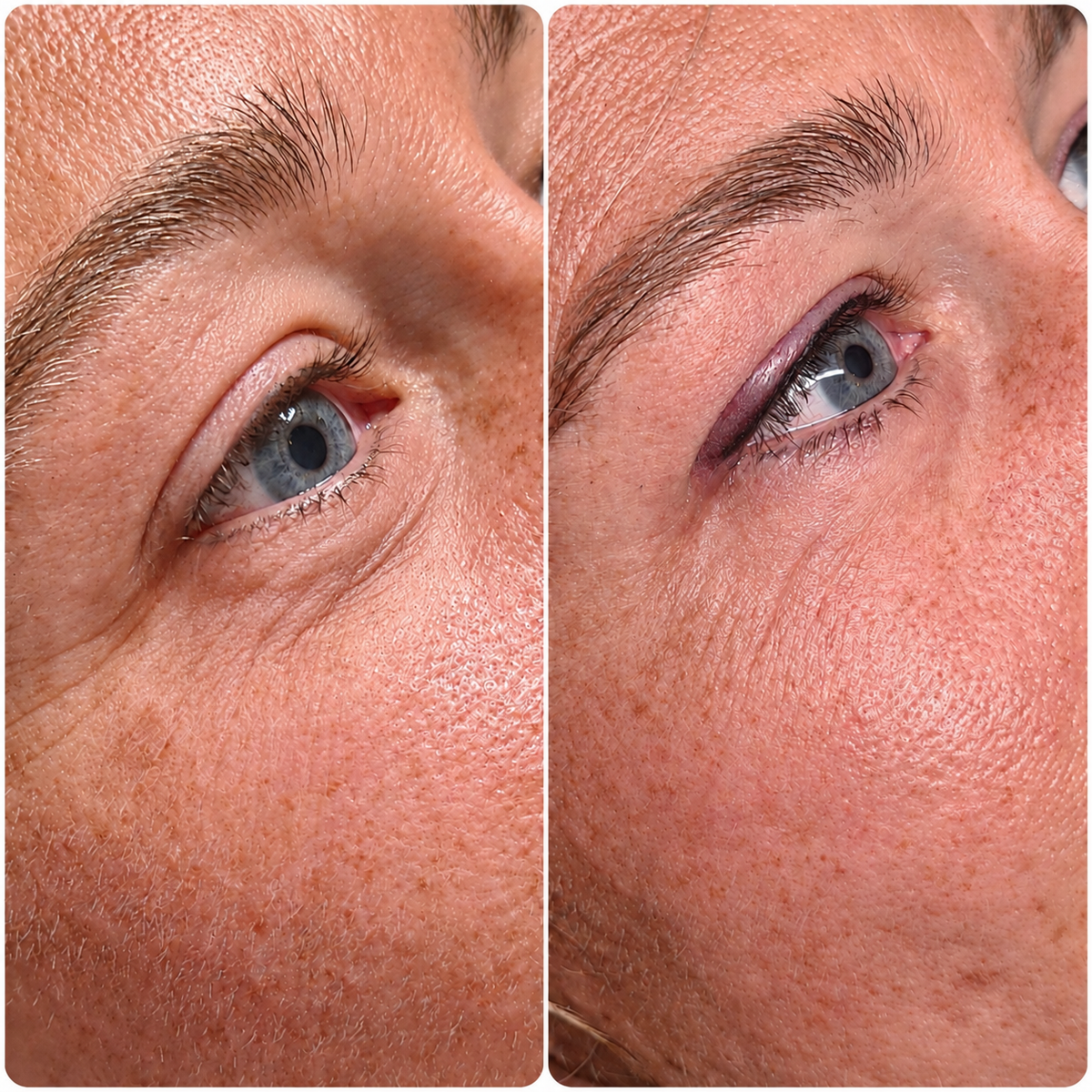 Auge vor und nach der Wimpernkranzverdichtung am oberen Lid